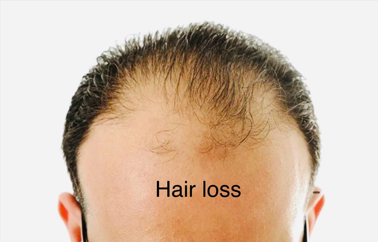 पुरुषों में बाल झड़ने के कारण: जानिए असली वजह और समाधान