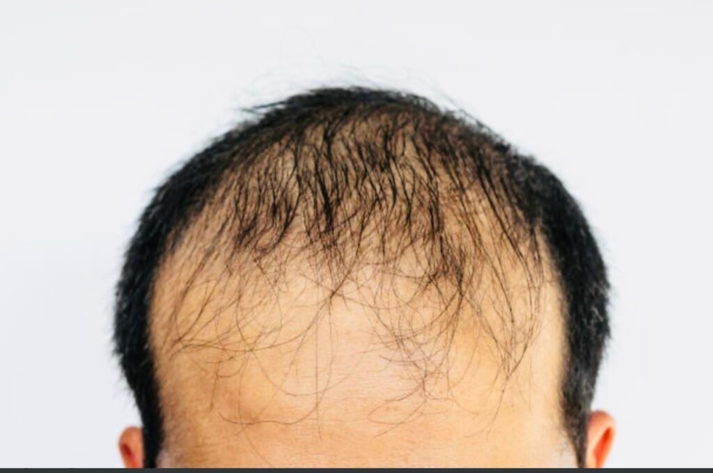 Types of hair loss
